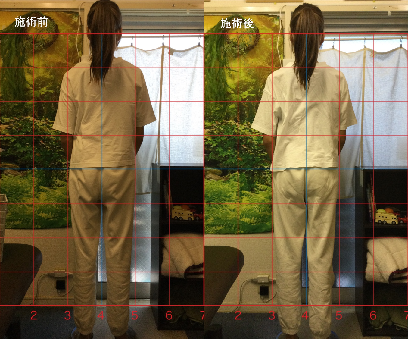 側弯症　マルファン症候群の女の子